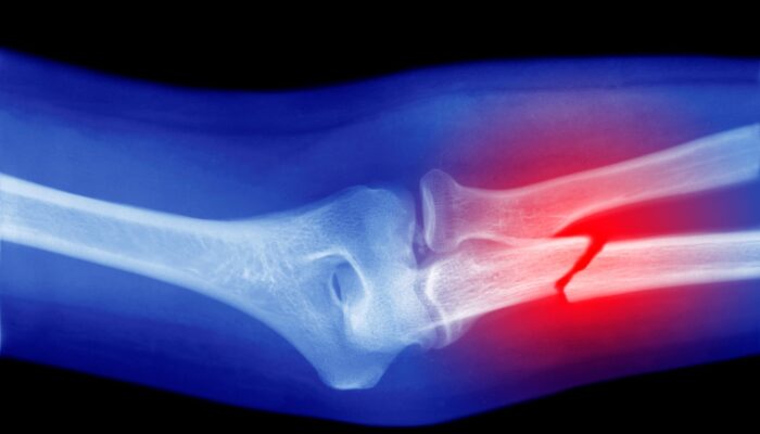 microplastics-could-be-weakening-your-bones,-research-suggests