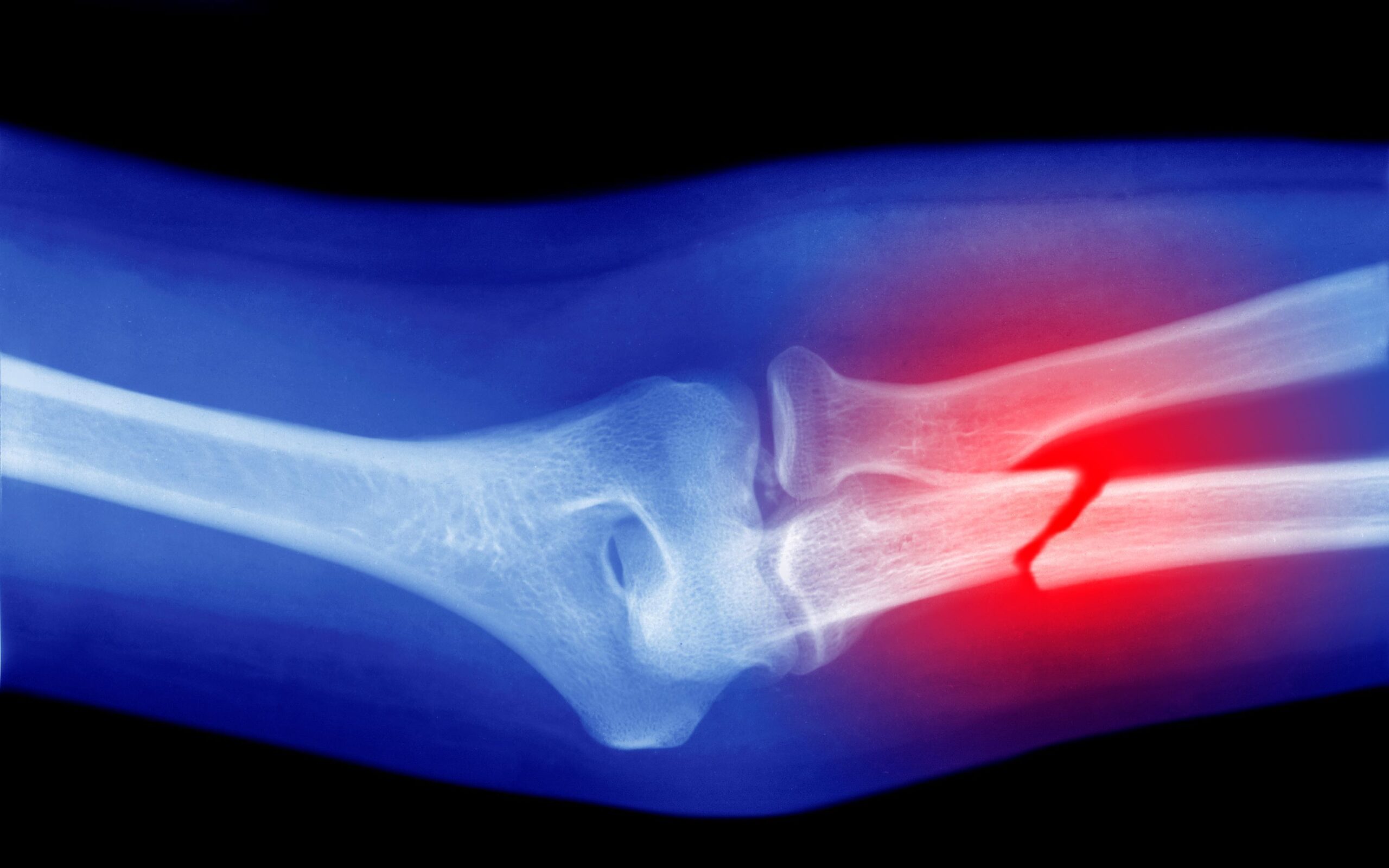 microplastics-could-be-weakening-your-bones,-research-suggests