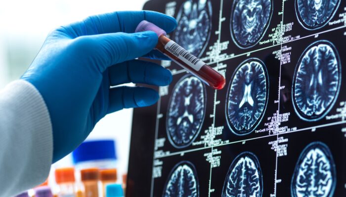 blood-tests-for-alzheimer’s-are-here